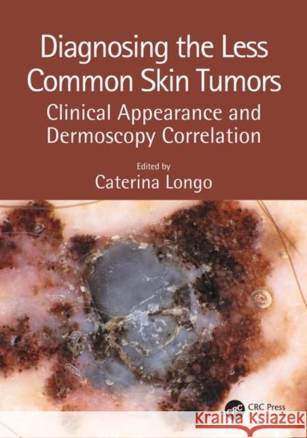 Diagnosing the Less Common Skin Tumors: Clinical Appearance and Dermoscopy Correlation Caterina Longo 9781138106628