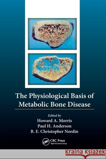 The Physiological Basis of Metabolic Bone Disease Borje Edgar Christopher Nordin Howard Arthur Morris Paul Anderson 9781138198708 CRC Press