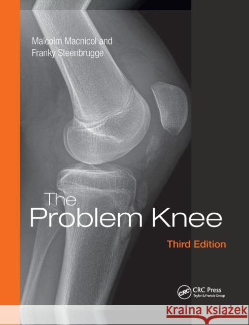The Problem Knee Malcolm Macnicol (Edinburgh, UK) Franky Steenbrugge (Kerksken, Belgium)  9781138372467 CRC Press