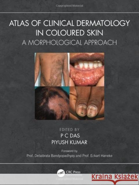 Atlas of Clinical Dermatology in Coloured Skin: A Morphological Approach  9781138483682 Taylor & Francis Ltd
