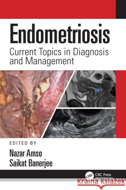 Endometriosis: Current Topics in Diagnosis and Management  9781138595873 CRC Press