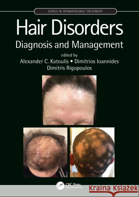 Hair Disorders: Diagnosis and Management Alexander C. Katoulis Dimitrios Ioannides Dimitris Rigopoulos 9781138611900 CRC Press