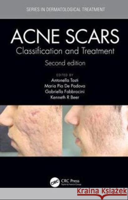 Acne Scars: Classification and Treatment, Second Edition A. Tosti Maria Pia d Gabriella Fabbrocini 9781138894228