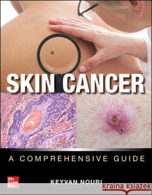 Skin Cancer: A Comprehensive Guide Keyvan Nouri 9781260453003