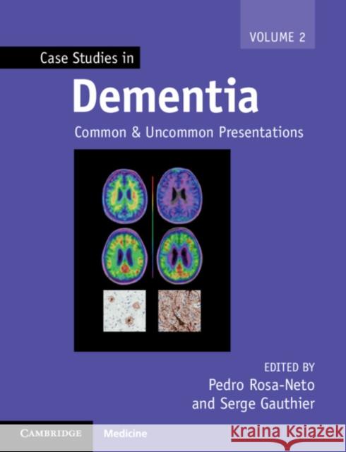 Case Studies in Dementia: Common and Uncommon Presentations Rosa-Neto, Pedro 9781316638057