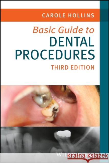 Basic Guide to Dental Procedures, 3rd Edition Carole (British Dental Association) Hollins 9781394187874 John Wiley & Sons Inc