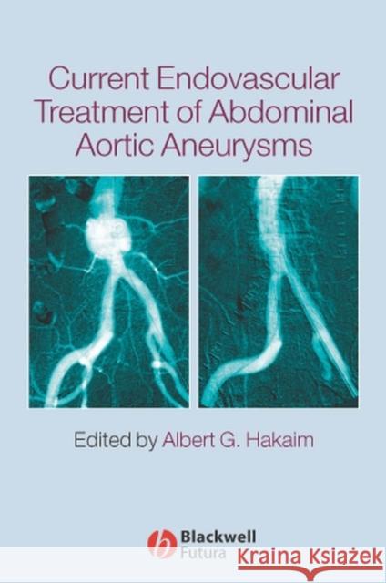 Current Endovascular Treatment of Abdominal Aortic Aneurysms Albert G. Hakaim 9781405122054 Blackwell Publishers