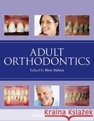 Adult Orthodontics Birte Melsen 9781405136198 