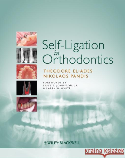 Self-Ligation in Orthodontics: An Evidence-Based Approach to Biomechanics and Treatment Eliades, Theodore 9781405181907 JOHN WILEY AND SONS LTD