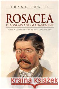 Rosacea: Diagnosis and Management Powell, Frank 9781420072587