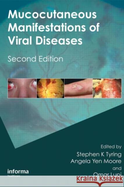 Mucocutaneous Manifestations of Viral Diseases: An Illustrated Guide to Diagnosis and Management Tyring, Stephen 9781420073126 Informa Healthcare