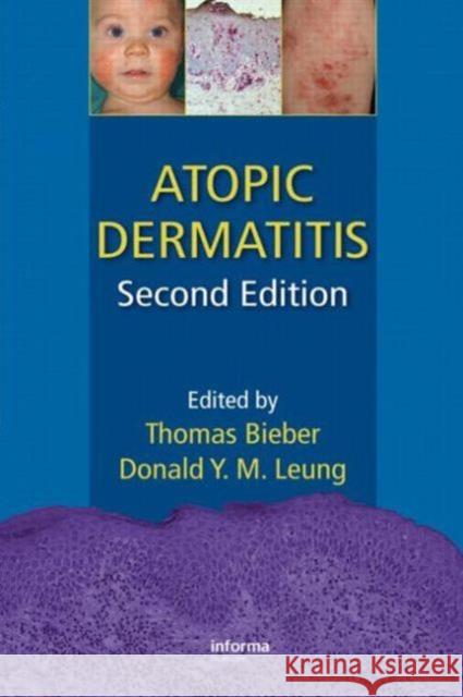 Atopic Dermatitis Thomas Bieber Donald Y. M. Leung 9781420077988