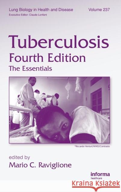 Tuberculosis: The Essentials, Fourth Edition Raviglione, Mario C. 9781420090215 Informa Healthcare