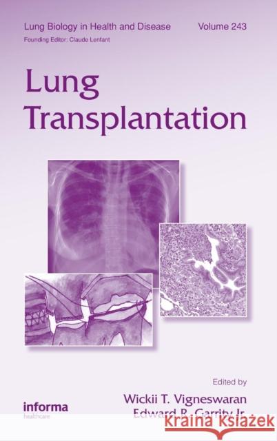 Lung Transplantation Wickii Vigneswaran Edward Garrity 9781439802557 Informa Healthcare