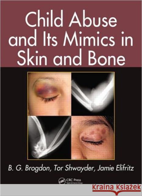 Child Abuse and Its Mimics in Skin and Bone Brogdon, B. G. 9781439855355 CRC Press