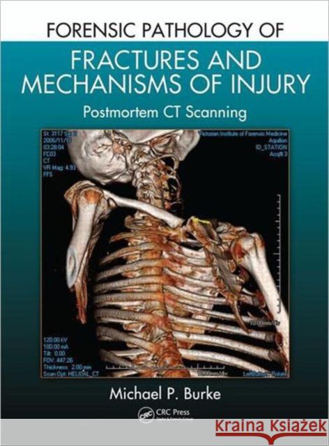 Forensic Pathology of Fractures and Mechanisms of Injury: Postmortem CT Scanning Burke, Michael P. 9781439881484 CRC Press