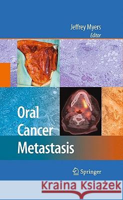 Oral Cancer Metastasis Jeffrey Myers 9781441907745