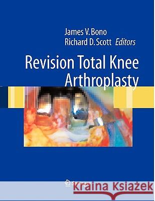 Revision Total Knee Arthroplasty James V. Bono Richard D. Scott C. S. Ranawat 9781441919748 Not Avail
