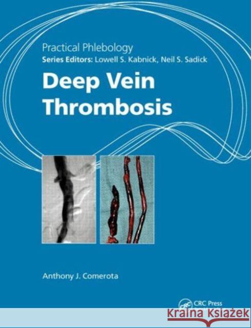 Deep Vein Thrombosis Comerota, Anthony J. 9781444146097 Hodder Arnold Publishers