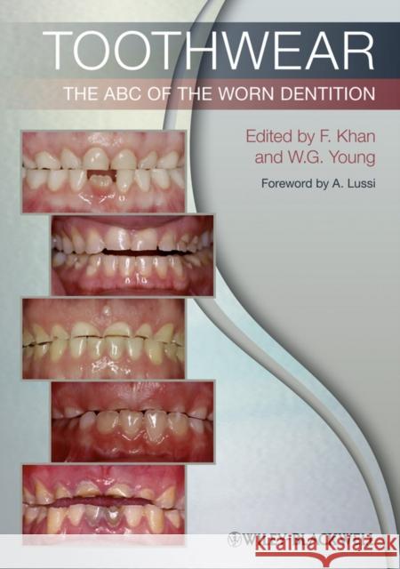 Toothwear: The ABC of the Worn Dentition Khan, Farid 9781444336559