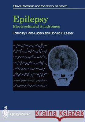 Epilepsy: Electroclinical Syndromes Lüders, Hans 9781447114031 Springer