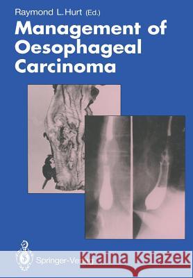 Management of Oesophageal Carcinoma Raymond L. Hurt 9781447131557 Springer