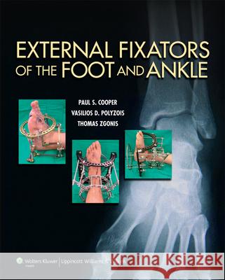External Fixators of the Foot and Ankle Paul Cooper 9781451171822 0