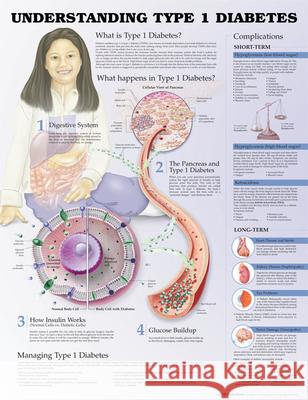 Understanding Type 1 Diabetes Anatomical Chart Anatomical Chart Company                 Jeff Unger 9781469894935 Acc Books