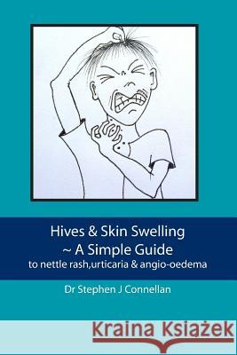 Hives & Skin Swelling A Simple Guide: to nettle rash, urticaria & angio-oedema Connellan, Stephen J. 9781477439340 Createspace