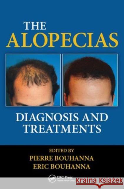 The Alopecias: Diagnosis and Treatments  9781482212754 Apple Academic Press