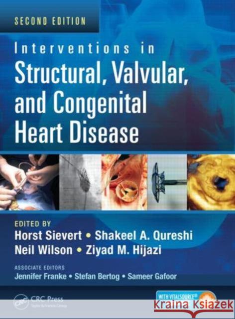 Interventions in Structural, Valvular and Congenital Heart Disease Horst Sievert Shakeel A. Qureshi Neil Wilson 9781482215632 CRC Press