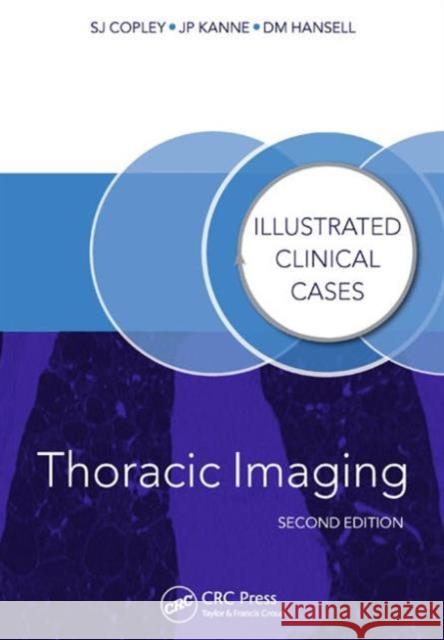 Thoracic Imaging: Illustrated Clinical Cases, Second Edition Copley, Sue 9781482231151 Taylor & Francis