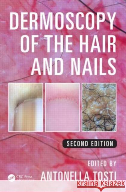 Dermoscopy of the Hair and Nails Antonella Tosti 9781482234053 CRC Press