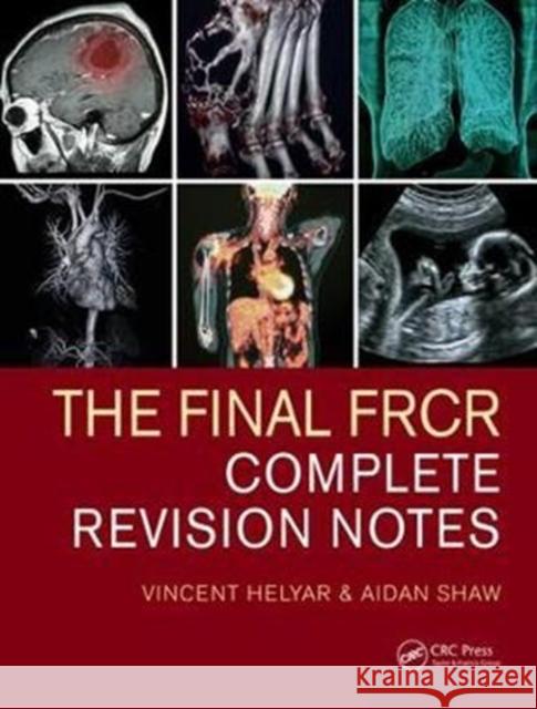 The Final Frcr: Complete Revision Notes Vincent Helyar 9781482259728 Apple Academic Press