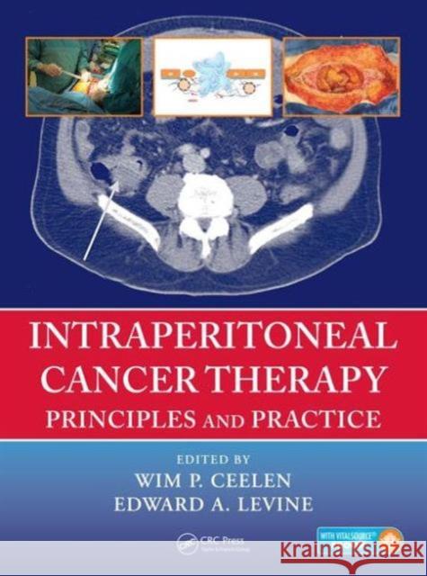 Intraperitoneal Cancer Therapy: Principles and Practice Wim P. Ceelen Edward Levine 9781482261189 CRC Press