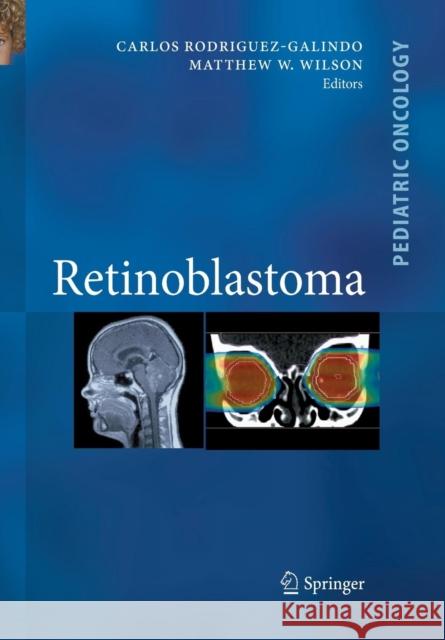 Retinoblastoma Matthew W. Wilson 9781489977533 Springer