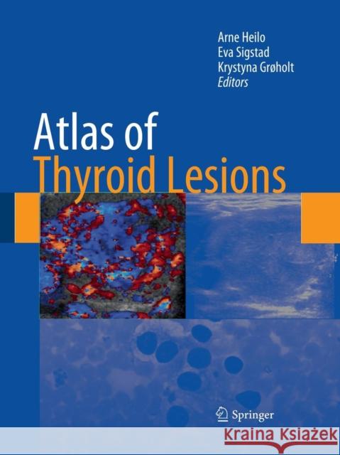 Atlas of Thyroid Lesions Arne Heilo Eva Sigstad Krystyna Grholt 9781493940813 Springer