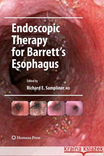 Endoscopic Therapy for Barrett's Esophagus Richard E. Sampliner 9781493961191 Humana Press