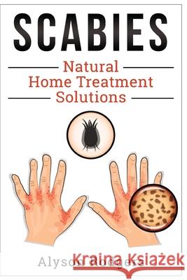 Scabies Natural Home Treatment Solution Alyson Rodgers 9781495405105