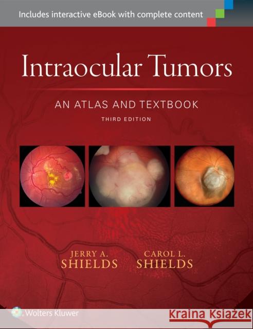 Intraocular Tumors: An Atlas and Textbook: Volume 1 Shields, Jerry A. 9781496321343 Lww
