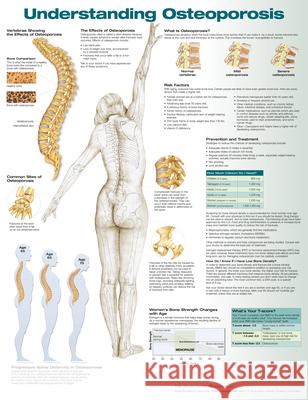 Understanding Osteoporosis Anatomical Chart Company   9781496362483 Lippincott Williams and Wilkins