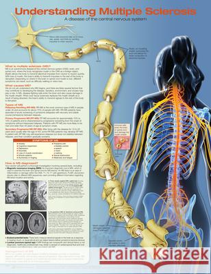 Understanding Multiple Sclerosis Anatomical Chart Laminated Anatomical Chart Company   9781496394989 Lippincott Williams and Wilkins