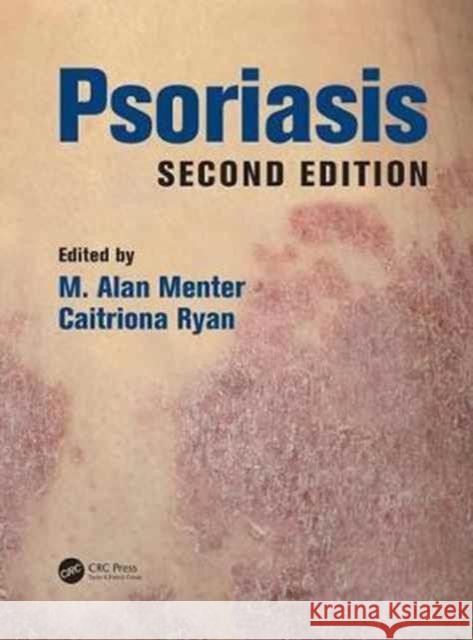 Psoriasis M. Alan Menter Caitriona Ryan 9781498700528