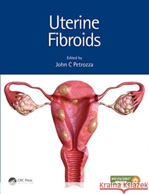 Uterine Fibroids John C. Petrozza   9781498739207 Productivity Press