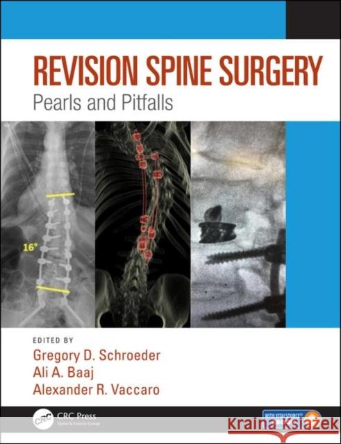 Revision Spine Surgery: Pearls and Pitfalls Schroeder, Gregory D. 9781498773829