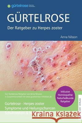 Gürtelrose - Der große Ratgeber zu Herpes zoster: Schulmedizin + Naturheilkunde Nilsson, Anna 9781532701672