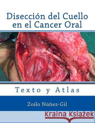 Diseccion del Cuello en el Cancer Oral Nunez-Gil, Zoilo 9781537623986 Createspace Independent Publishing Platform