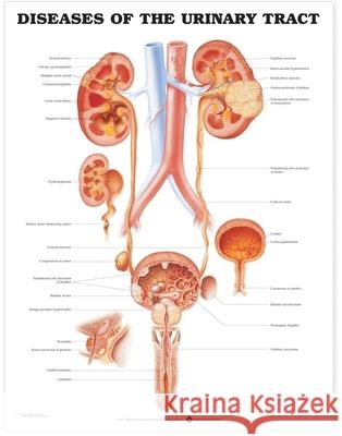 Diseases of the Urinary Tract Anatomical Chart  9781587792427 ANATOMICAL CHART CO ,U.S.