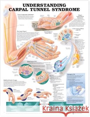 Understanding Carpal Tunnel Syndrome Anatomical Chart  Anatomical Chart Company 9781587793219 0