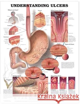 UNDERSTANDING ULCERS ANATOMICAL CHART  9781587793707 ANATOMICAL CHART CO ,U.S.